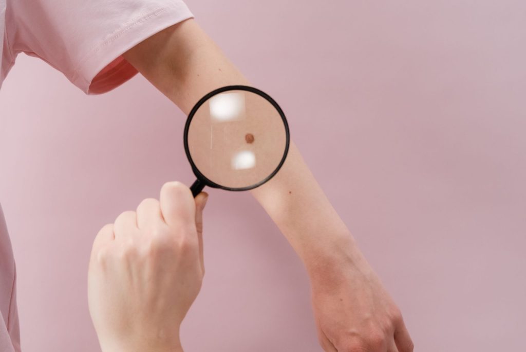 Gydytoja dermatovenerologė Sandra Bytautienė apie melanomos požymius ir ABCDE taisyklę